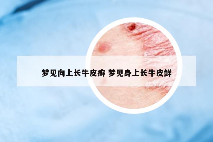 夢(mèng)見向上長牛皮癬 夢(mèng)見身上長牛皮鮮
