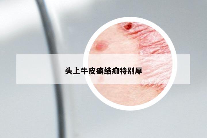 頭上牛皮癬結(jié)痂特別厚