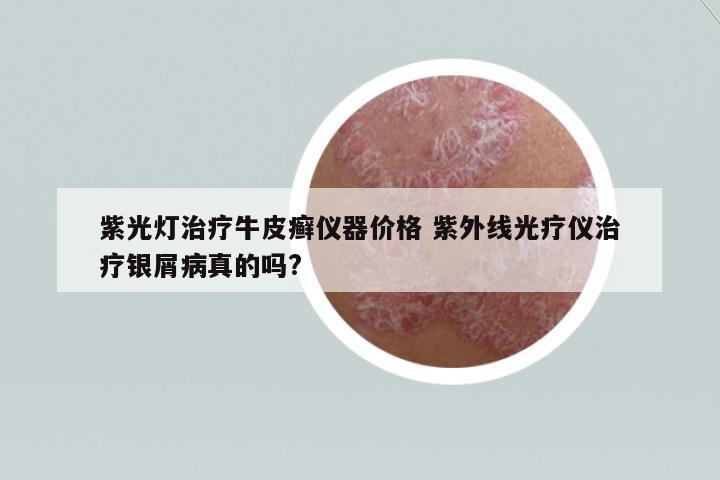 紫光燈治療牛皮癬儀器價格 紫外線光療儀治療銀屑病真的嗎?