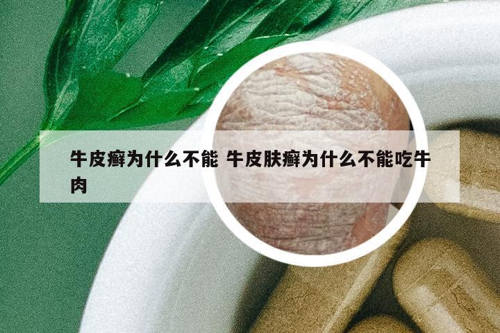牛皮癬為什么不能 牛皮膚癬為什么不能吃牛肉