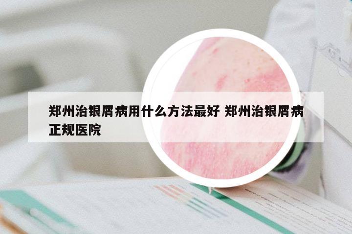 鄭州治銀屑病用什么方法最好 鄭州治銀屑病正規(guī)醫(yī)院