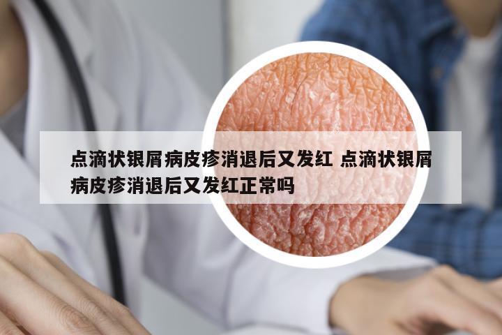 點滴狀銀屑病皮疹消退后又發(fā)紅 點滴狀銀屑病皮疹消退后又發(fā)紅正常嗎