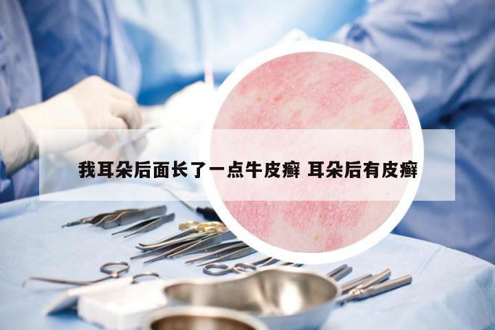我耳朵后面長(zhǎng)了一點(diǎn)牛皮癬 耳朵后有皮癬