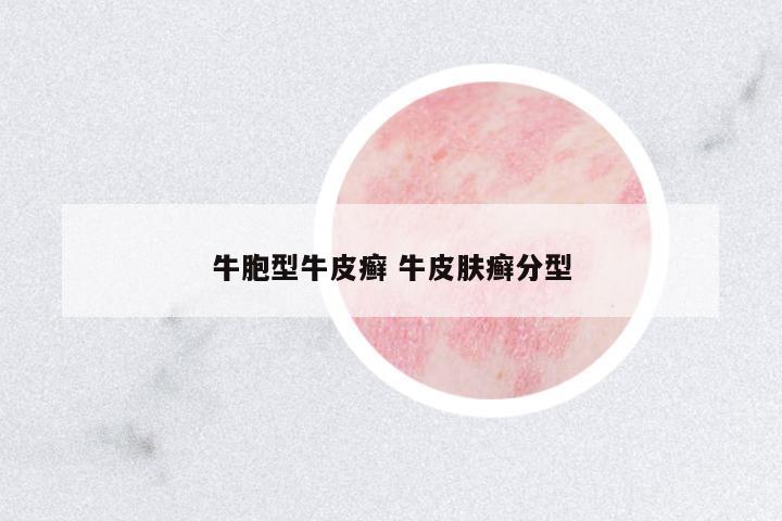 牛胞型牛皮癬 牛皮膚癬分型