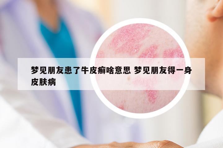 夢見朋友患了牛皮癬啥意思 夢見朋友得一身皮膚病
