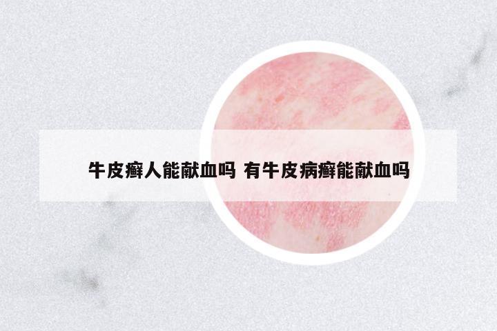 牛皮癬人能獻(xiàn)血嗎 有牛皮病癬能獻(xiàn)血嗎