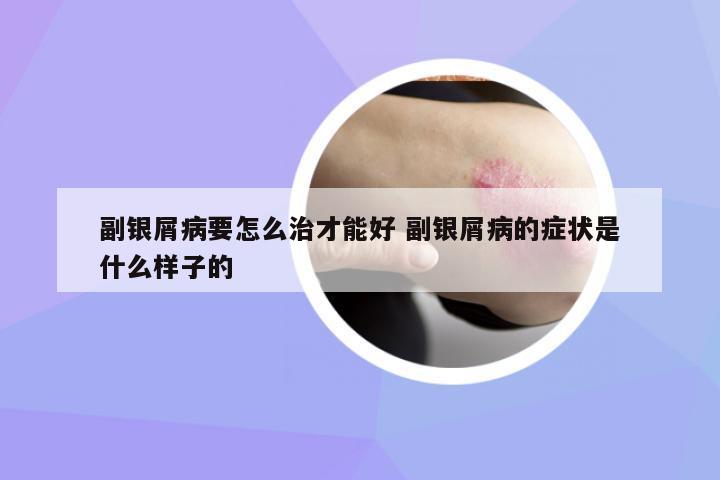 副銀屑病要怎么治才能好 副銀屑病的癥狀是什么樣子的