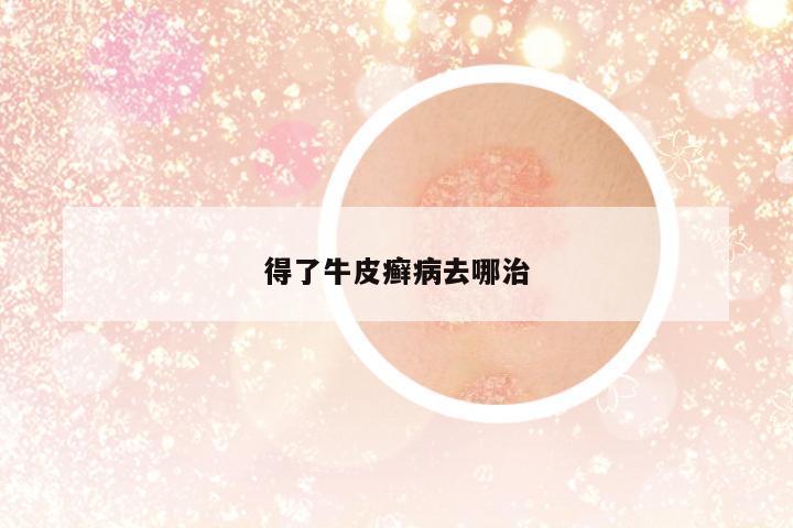 得了牛皮癬病去哪治