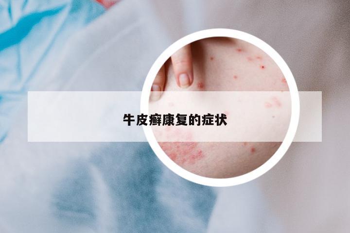 牛皮癬康復(fù)的癥狀