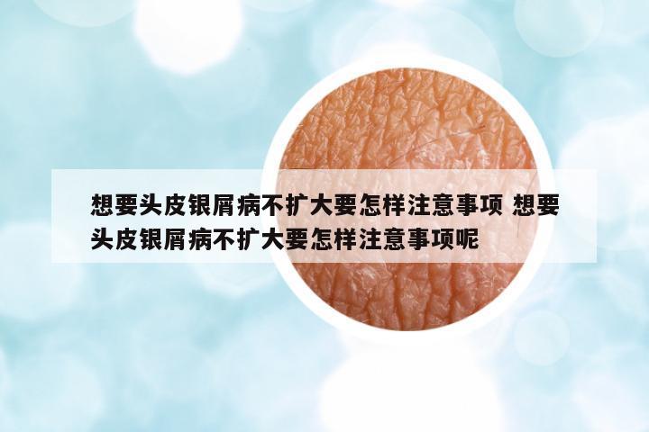 想要頭皮銀屑病不擴(kuò)大要怎樣注意事項(xiàng) 想要頭皮銀屑病不擴(kuò)大要怎樣注意事項(xiàng)呢