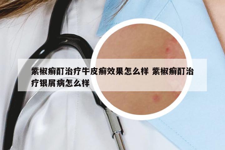 紫椒癬酊治療牛皮癬效果怎么樣 紫椒癬酊治療銀屑病怎么樣