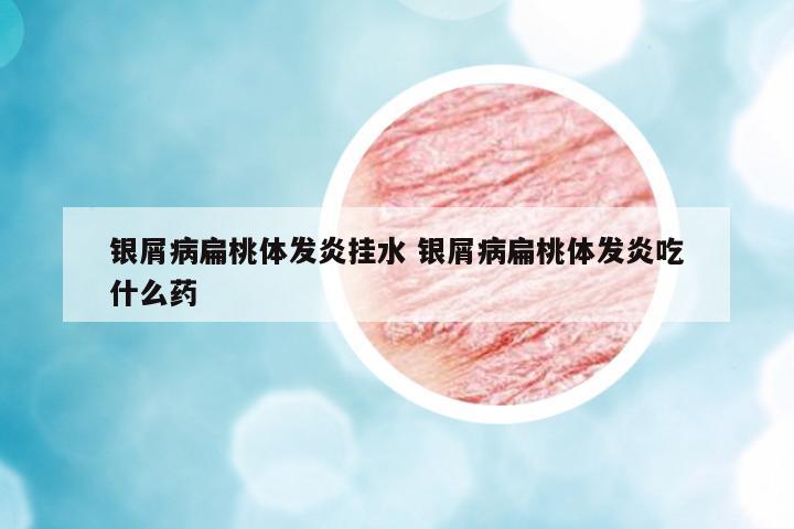 銀屑病扁桃體發(fā)炎掛水 銀屑病扁桃體發(fā)炎吃什么藥