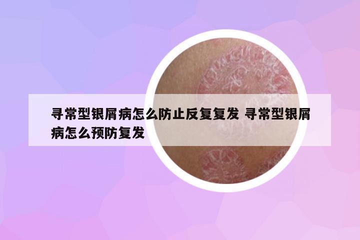 尋常型銀屑病怎么防止反復(fù)復(fù)發(fā) 尋常型銀屑病怎么預(yù)防復(fù)發(fā)