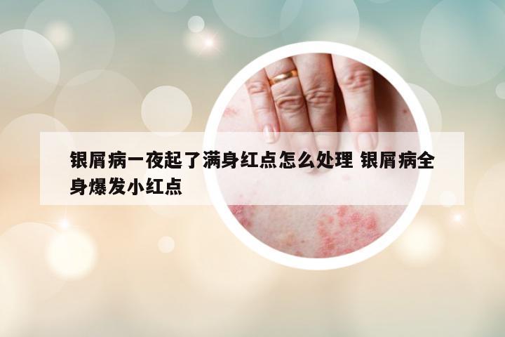銀屑病一夜起了滿身紅點怎么處理 銀屑病全身爆發(fā)小紅點