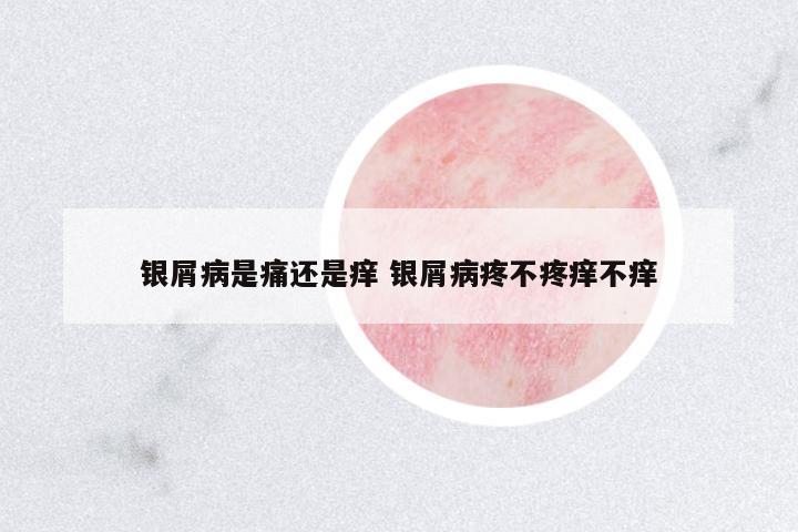 銀屑病是痛還是癢 銀屑病疼不疼癢不癢