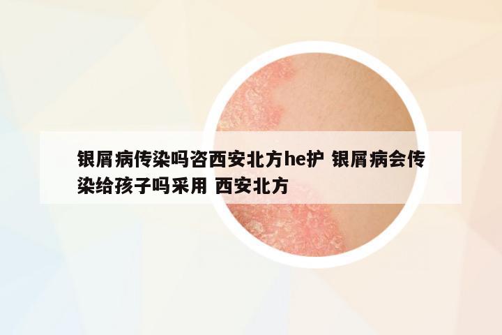 銀屑病傳染嗎咨西安北方he護 銀屑病會傳染給孩子嗎采用 西安北方
