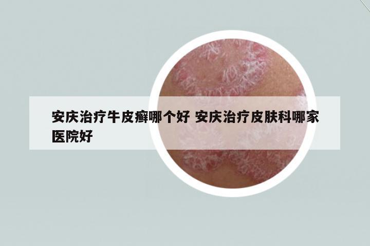 安慶治療牛皮癬哪個(gè)好 安慶治療皮膚科哪家醫(yī)院好