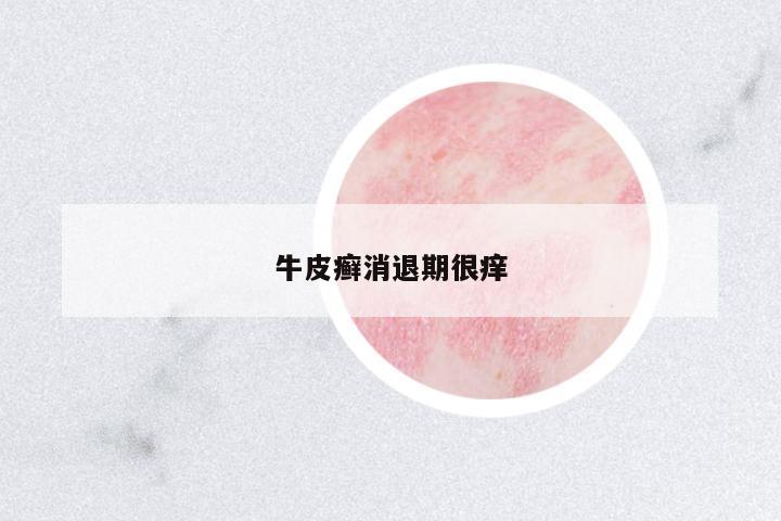 牛皮癬消退期很癢