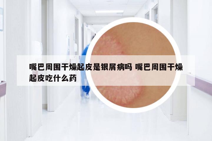 嘴巴周圍干燥起皮是銀屑病嗎 嘴巴周圍干燥起皮吃什么藥