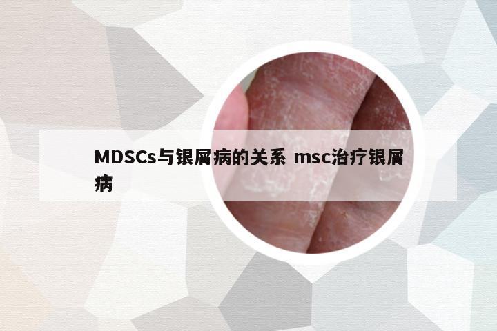 MDSCs與銀屑病的關(guān)系 msc治療銀屑病