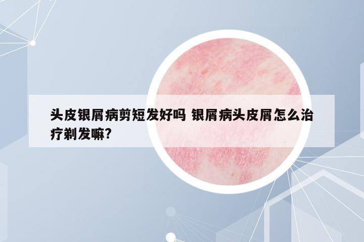 頭皮銀屑病剪短發(fā)好嗎 銀屑病頭皮屑怎么治療剃發(fā)嘛?