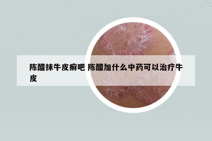 陳醋抹牛皮癬吧 陳醋加什么中藥可以治療牛皮