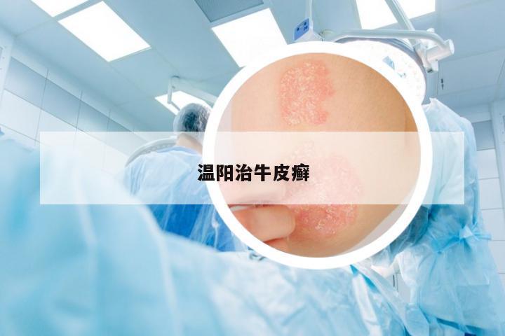 溫陽治牛皮癬