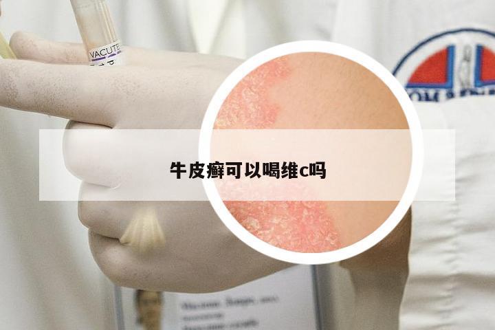 牛皮癬可以喝維c嗎