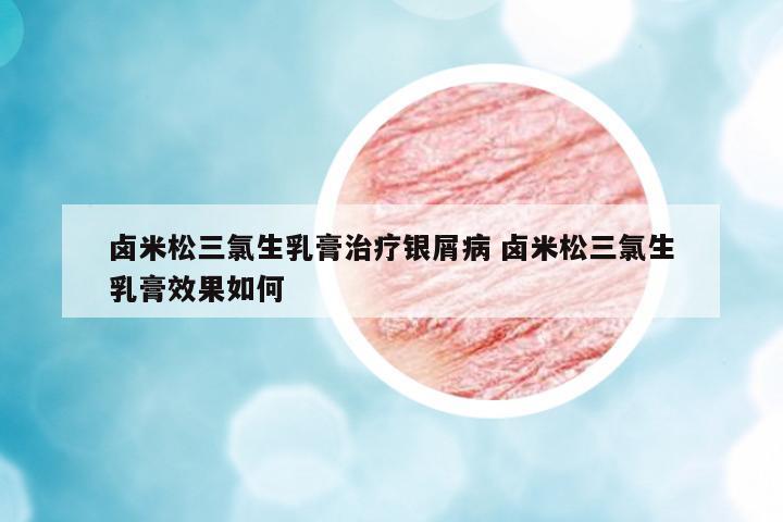 鹵米松三氯生乳膏治療銀屑病 鹵米松三氯生乳膏效果如何