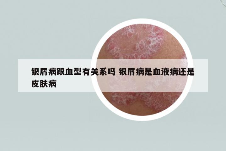 銀屑病跟血型有關(guān)系嗎 銀屑病是血液病還是皮膚病