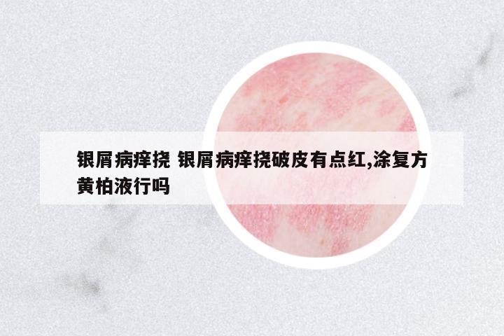 銀屑病癢撓 銀屑病癢撓破皮有點(diǎn)紅,涂復(fù)方黃柏液行嗎