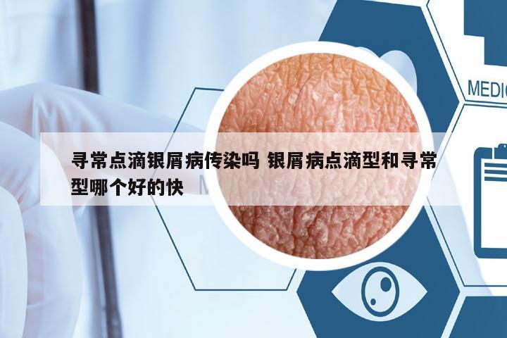 尋常點滴銀屑病傳染嗎 銀屑病點滴型和尋常型哪個好的快