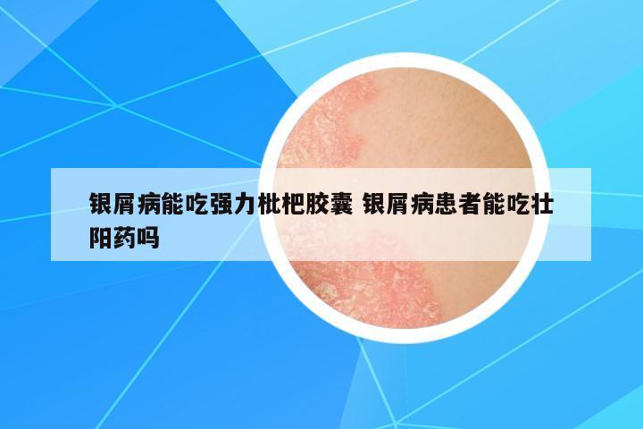 銀屑病能吃強(qiáng)力枇杷膠囊 銀屑病患者能吃壯陽藥嗎