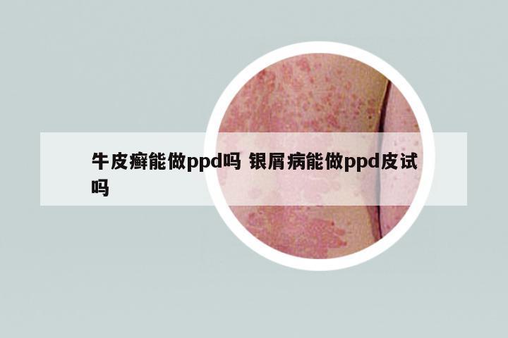 牛皮癬能做ppd嗎 銀屑病能做ppd皮試嗎