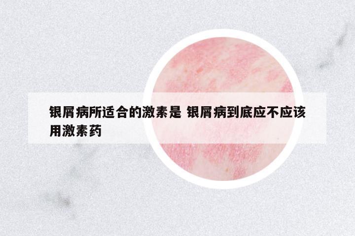 銀屑病所適合的激素是 銀屑病到底應(yīng)不應(yīng)該用激素藥