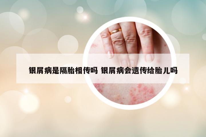 銀屑病是隔胎相傳嗎 銀屑病會遺傳給胎兒嗎