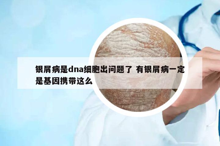 銀屑病是dna細(xì)胞出問題了 有銀屑病一定是基因攜帶這么