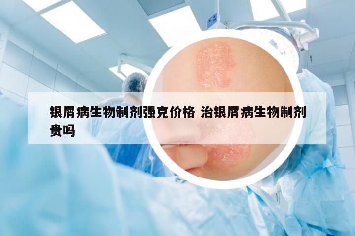 銀屑病生物制劑強克價格 治銀屑病生物制劑貴嗎