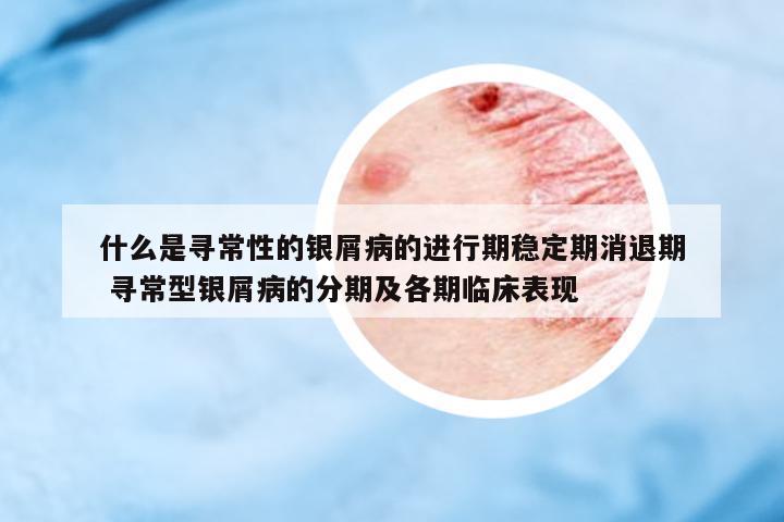 什么是尋常性的銀屑病的進行期穩(wěn)定期消退期 尋常型銀屑病的分期及各期臨床表現(xiàn)
