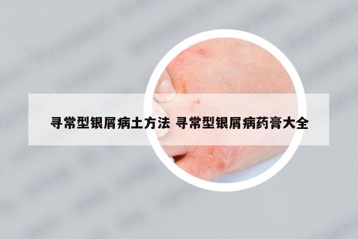 尋常型銀屑病土方法 尋常型銀屑病藥膏大全