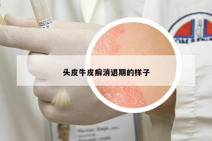 頭皮牛皮癬消退期的樣子