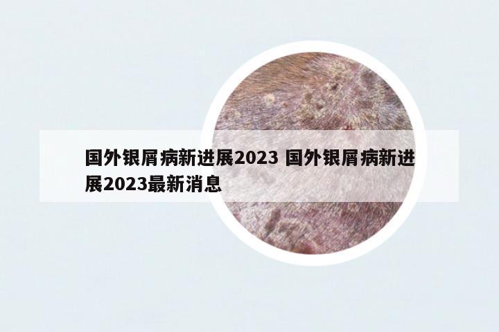國(guó)外銀屑病新進(jìn)展2023 國(guó)外銀屑病新進(jìn)展2023最新消息