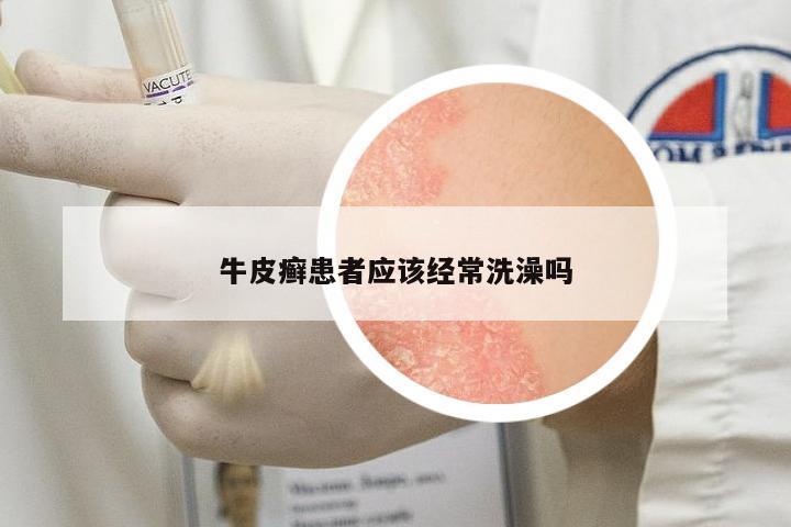 牛皮癬患者應該經(jīng)常洗澡嗎