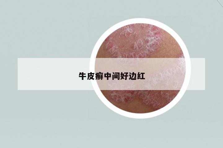 牛皮癬中間好邊紅