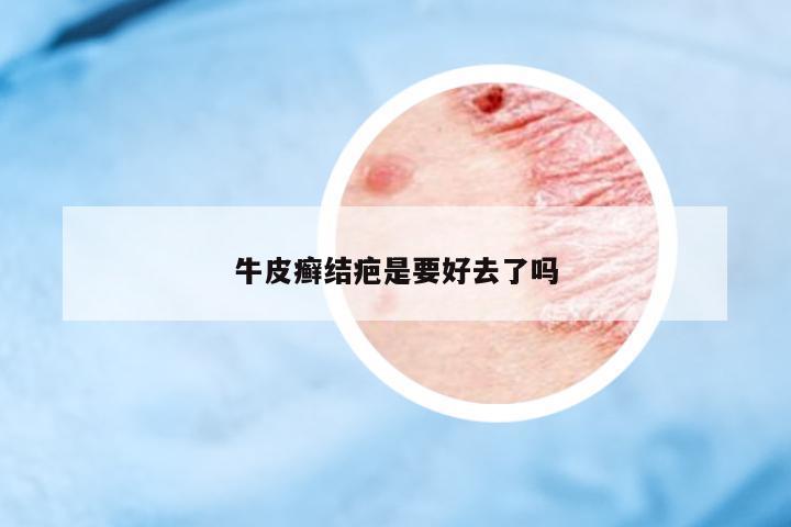 牛皮癬結(jié)疤是要好去了嗎