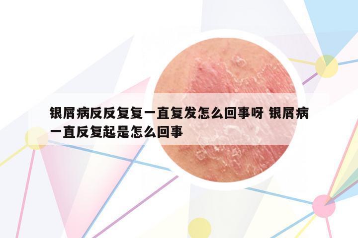 銀屑病反反復(fù)復(fù)一直復(fù)發(fā)怎么回事呀 銀屑病一直反復(fù)起是怎么回事