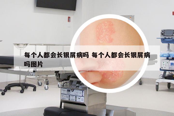 每個(gè)人都會(huì)長(zhǎng)銀屑病嗎 每個(gè)人都會(huì)長(zhǎng)銀屑病嗎圖片