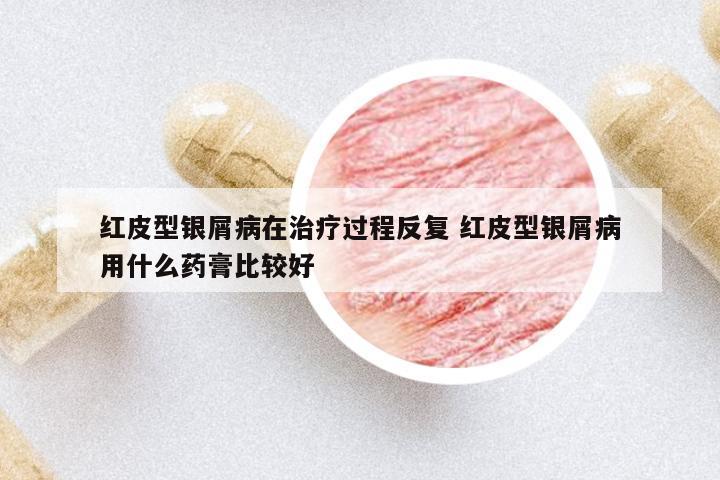 紅皮型銀屑病在治療過程反復(fù) 紅皮型銀屑病用什么藥膏比較好