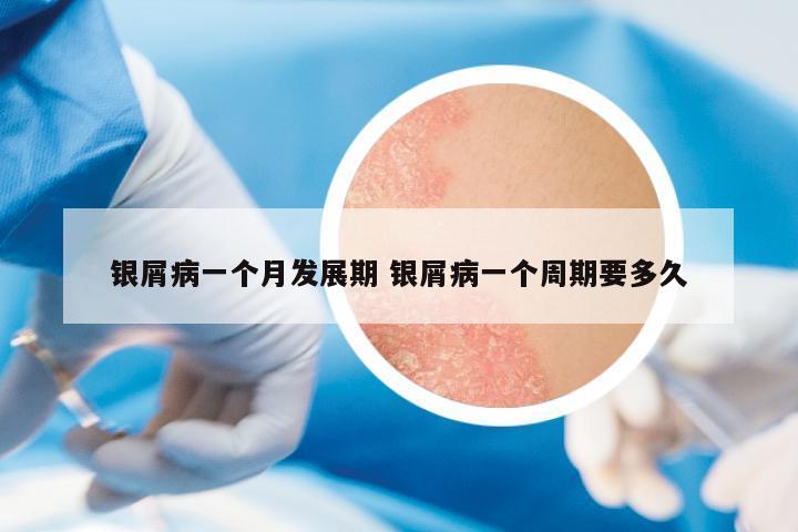 銀屑病一個月發(fā)展期 銀屑病一個周期要多久