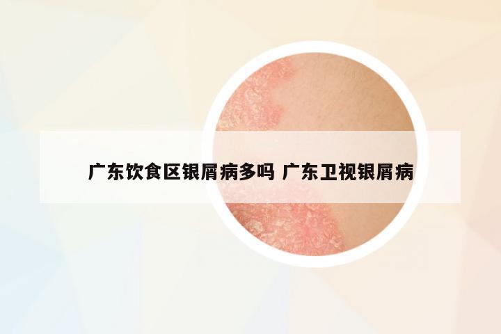 廣東飲食區(qū)銀屑病多嗎 廣東衛(wèi)視銀屑病